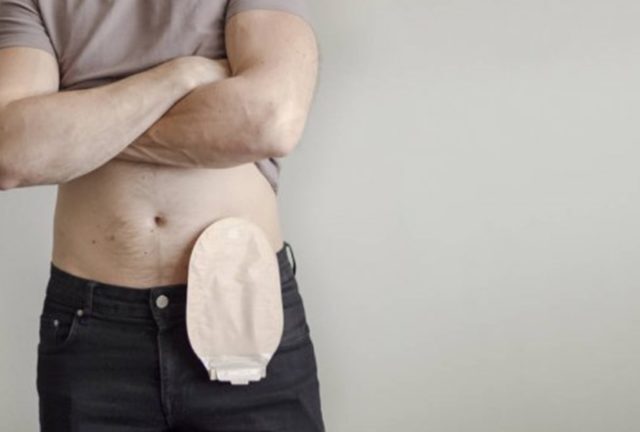 Qual é a diferença entre colostomia e ileostomia, como a de Preta Gil? Especialista explica