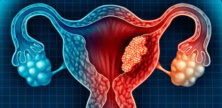 Endometriose aumenta risco de câncer de ovário em quatro vezes, diz estudo